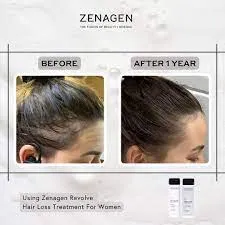 Revolve Women's Hair Loss Kit